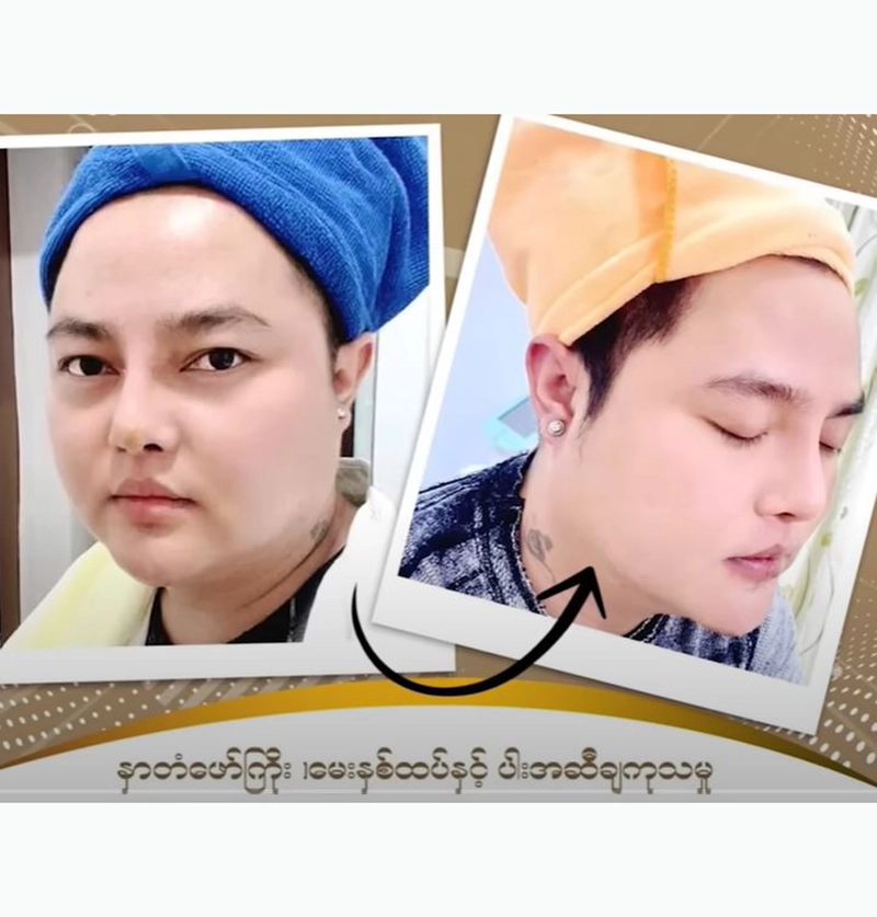 Swan Zar Ni is undergoing beauty therapy to look younger <img src="https://news.oneday.press/wp-content/uploads/2024/06/486v.webp" alt="Swan Zar Ni is undergoing beauty therapy to look younger">